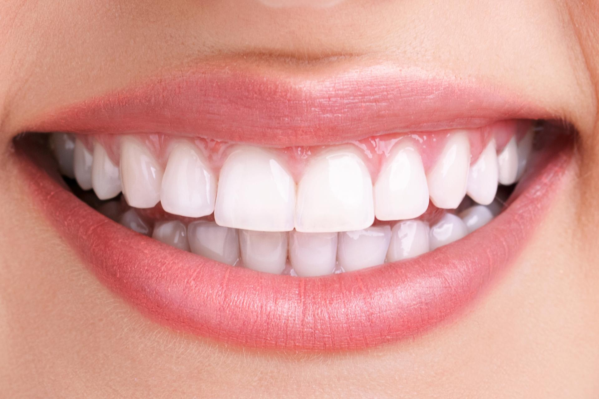 Teeth Whitening Treatment Oakville | Dr. Agatha bis | Smiles by Bis