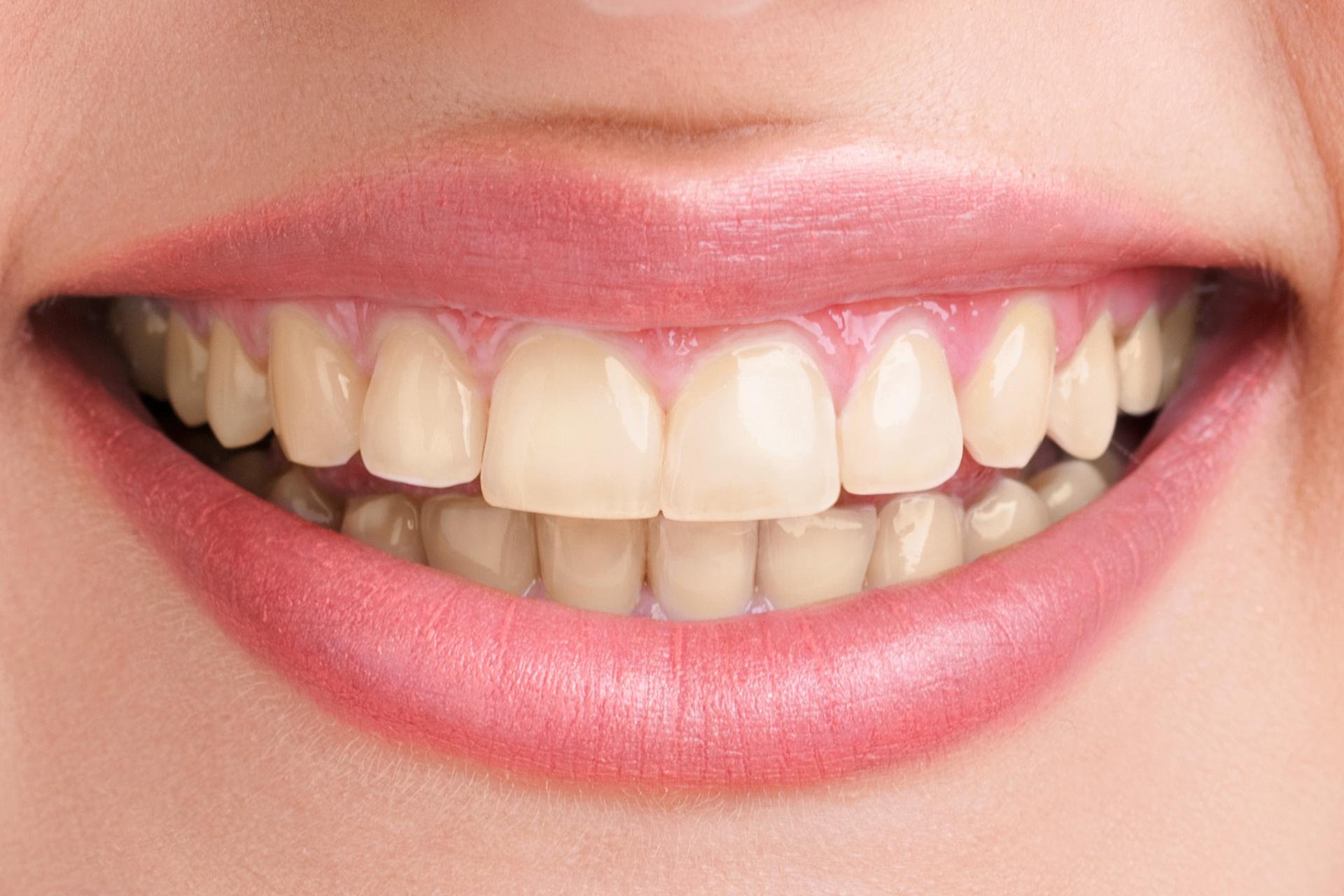 Teeth Whitening Treatment In Oakville | Smiles by Bis
