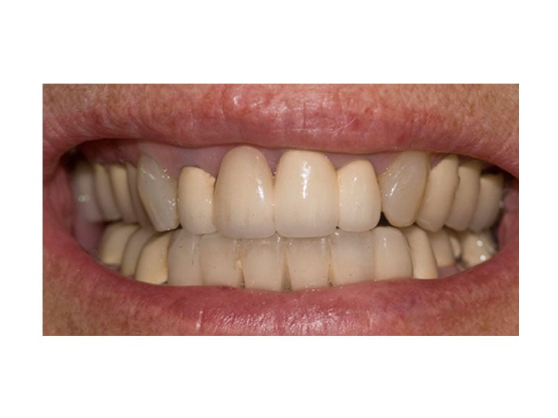 Cosmetic Dentistry Mistakes | Smiles By Bis
