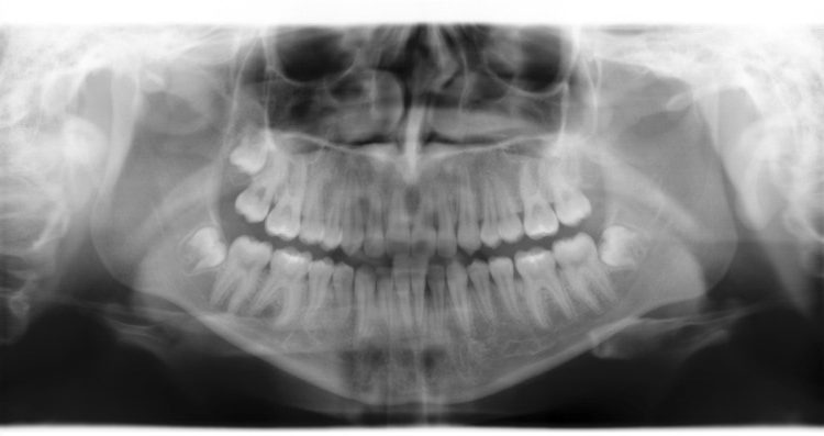 TMJ Symptons Mouth Pan-X-ray | Smiles By Bis