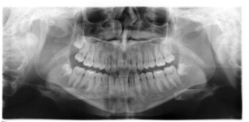 TMJ Symptons Mouth Pan-X-ray | Smiles By Bis
