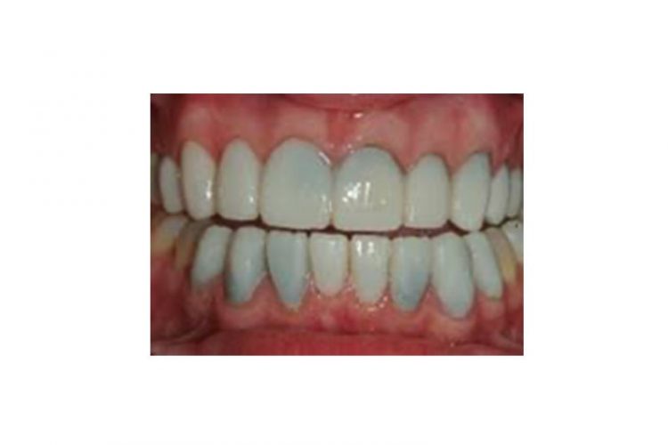Leaky Veneers Oakville Dentist | Smiles By Bis