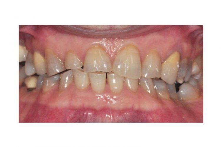Para Function Cosmetic Dentist Oakville | Smiles By Bis