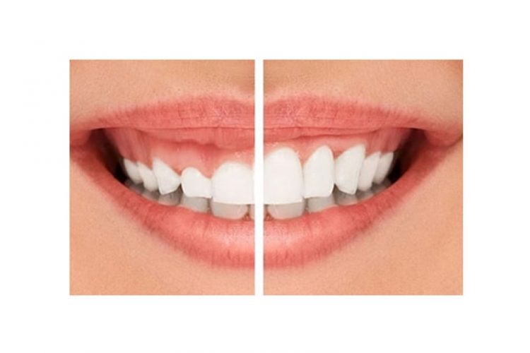 Best Dentist For Smile Makeover In Oakville | Smiles By Bis