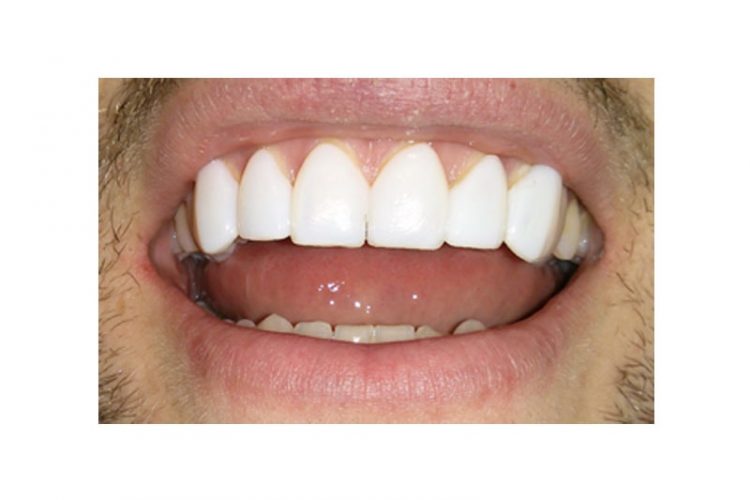 Whiter Teeth Oakville | Smiles By Bis