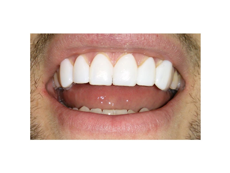 Whiter Teeth Oakville | Smiles By Bis