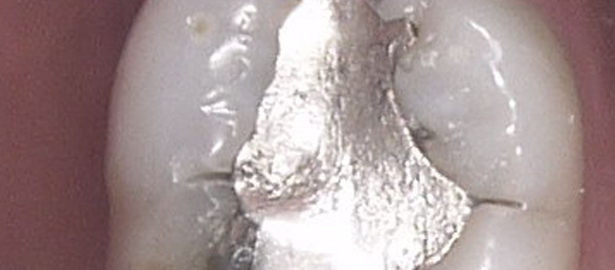 The Safety of Dental Amalgam Smiles By Bis