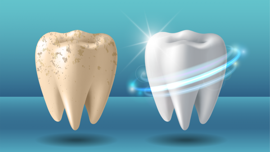 Teeth Whitening Oakville | Smiles By Bis