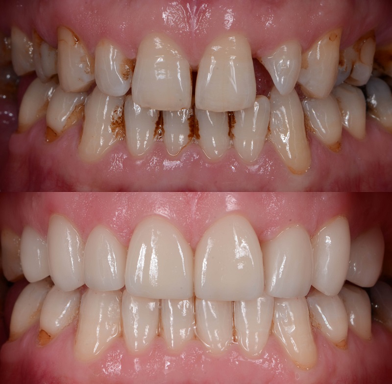 Teeth Makeover in Oakville | Smiles by Bis