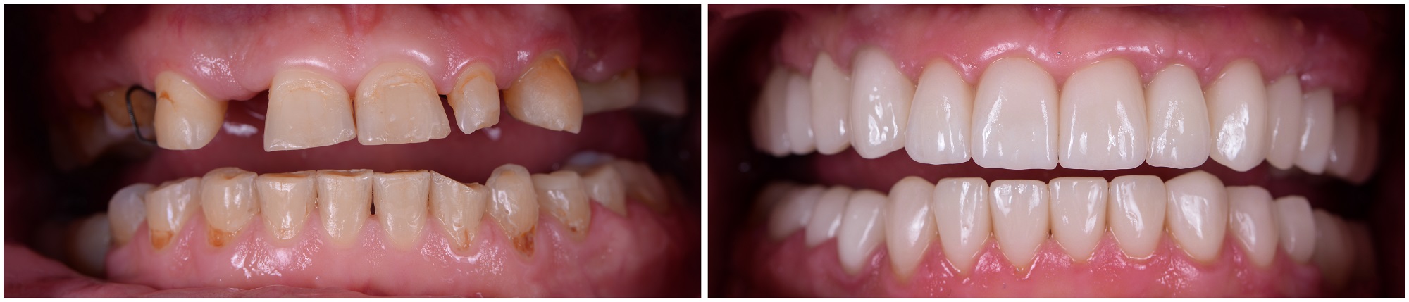 Teeth Makeover In Oakville | Smiles by Bis
