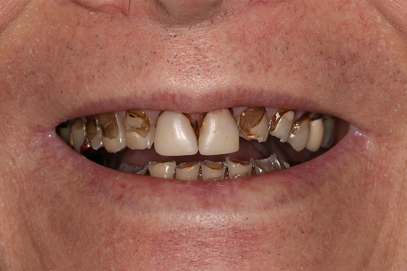 Veneers Treatment For Crooked Teeth Oakville | Smiles By Bis