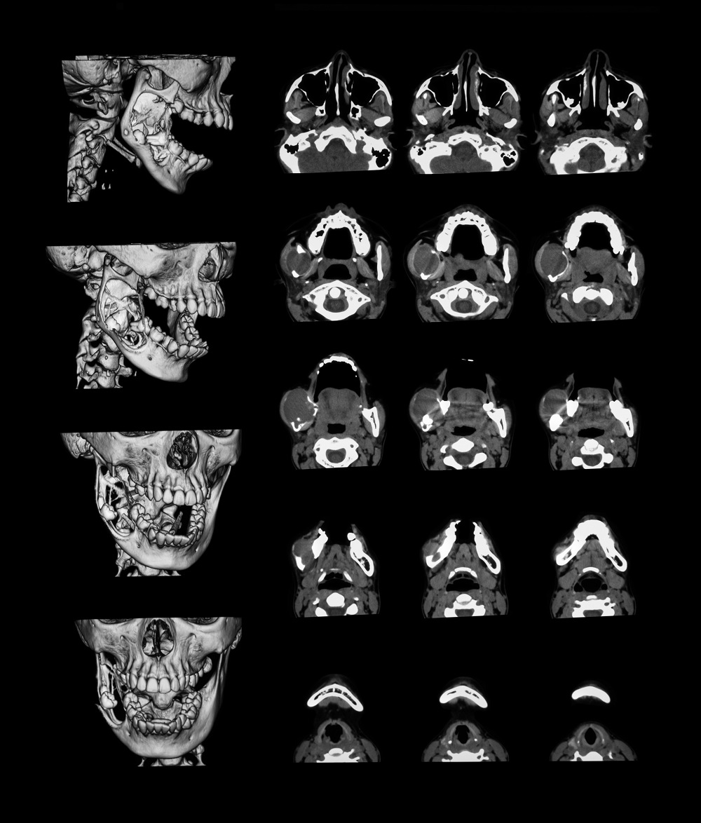 Computed Tomography Of Dental | Smiles By Bis
