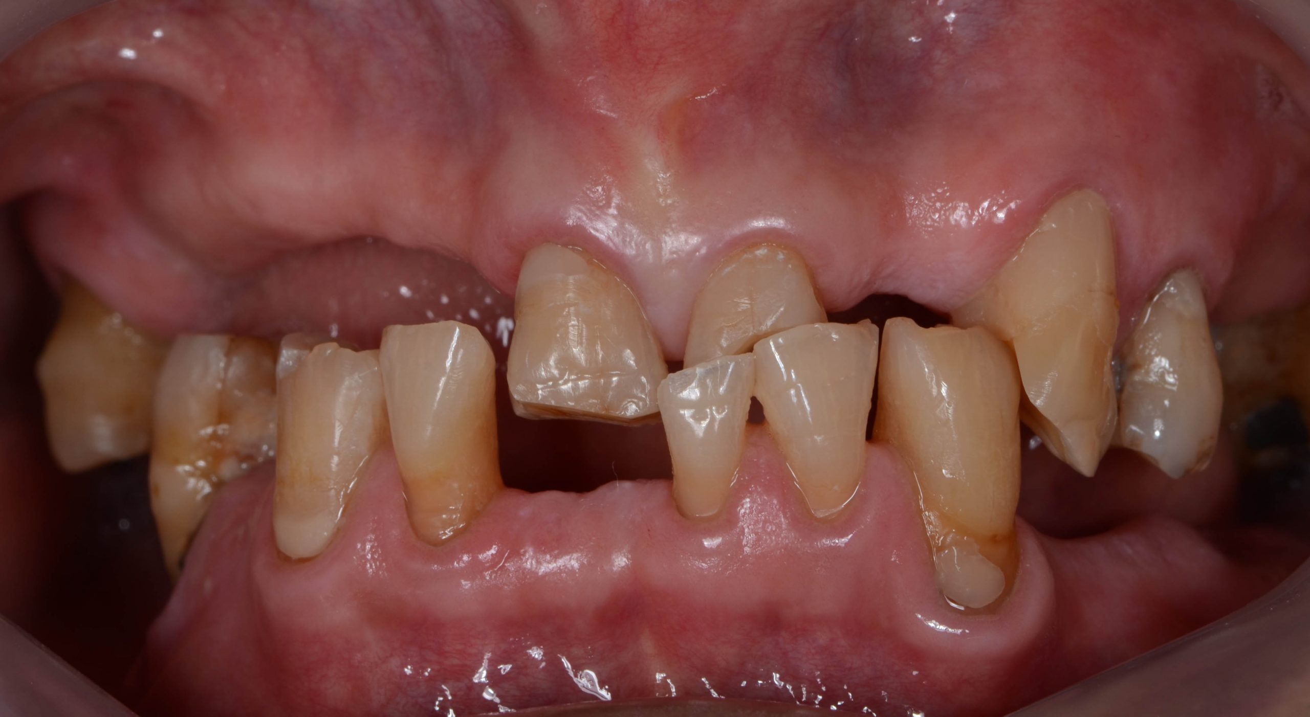 Gnashing Teeth Gnashing Teeth