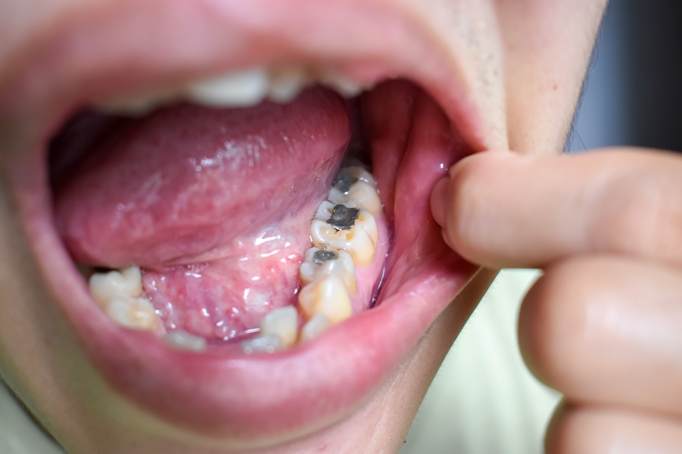 Safe Mercury Amalgam Removal Technique SMART How To Remove Mercury 