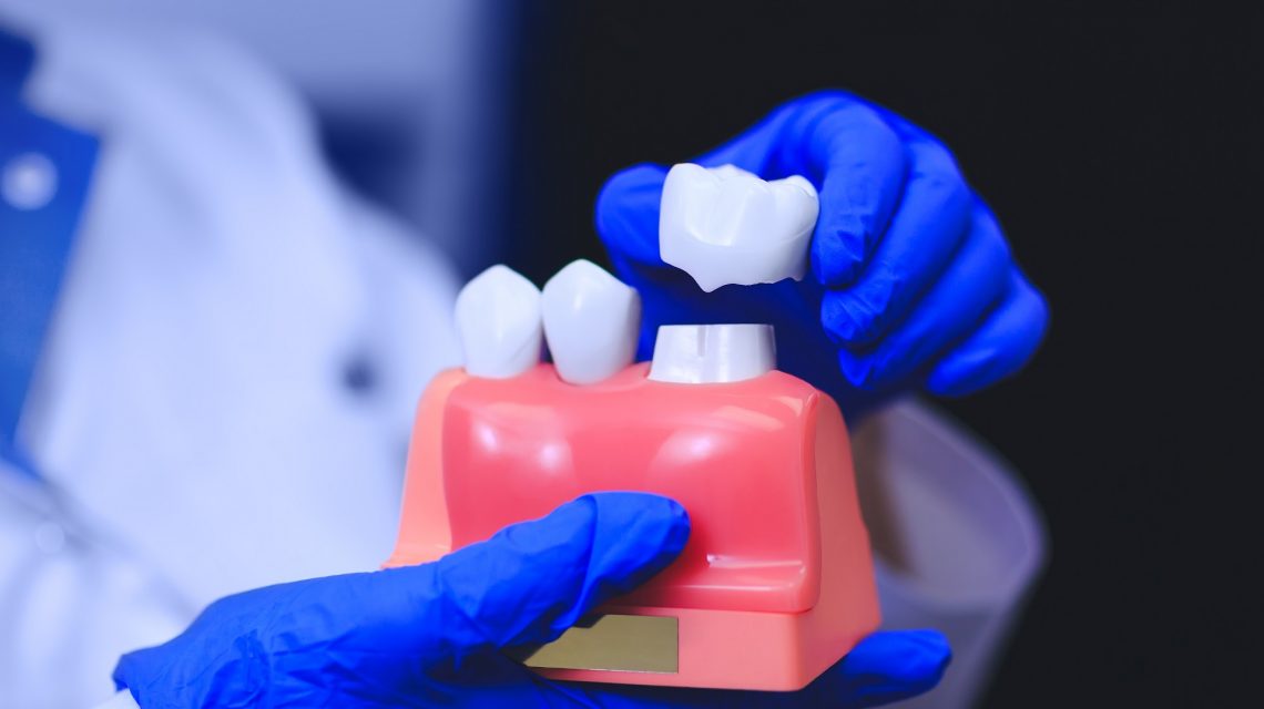 Can Dental Crowns Get Cavities