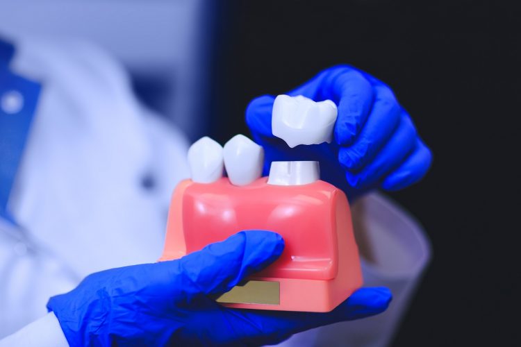 Can Dental Crowns Get Cavities