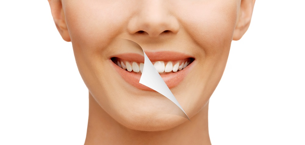 Teeth Whitening Treatment Oakville