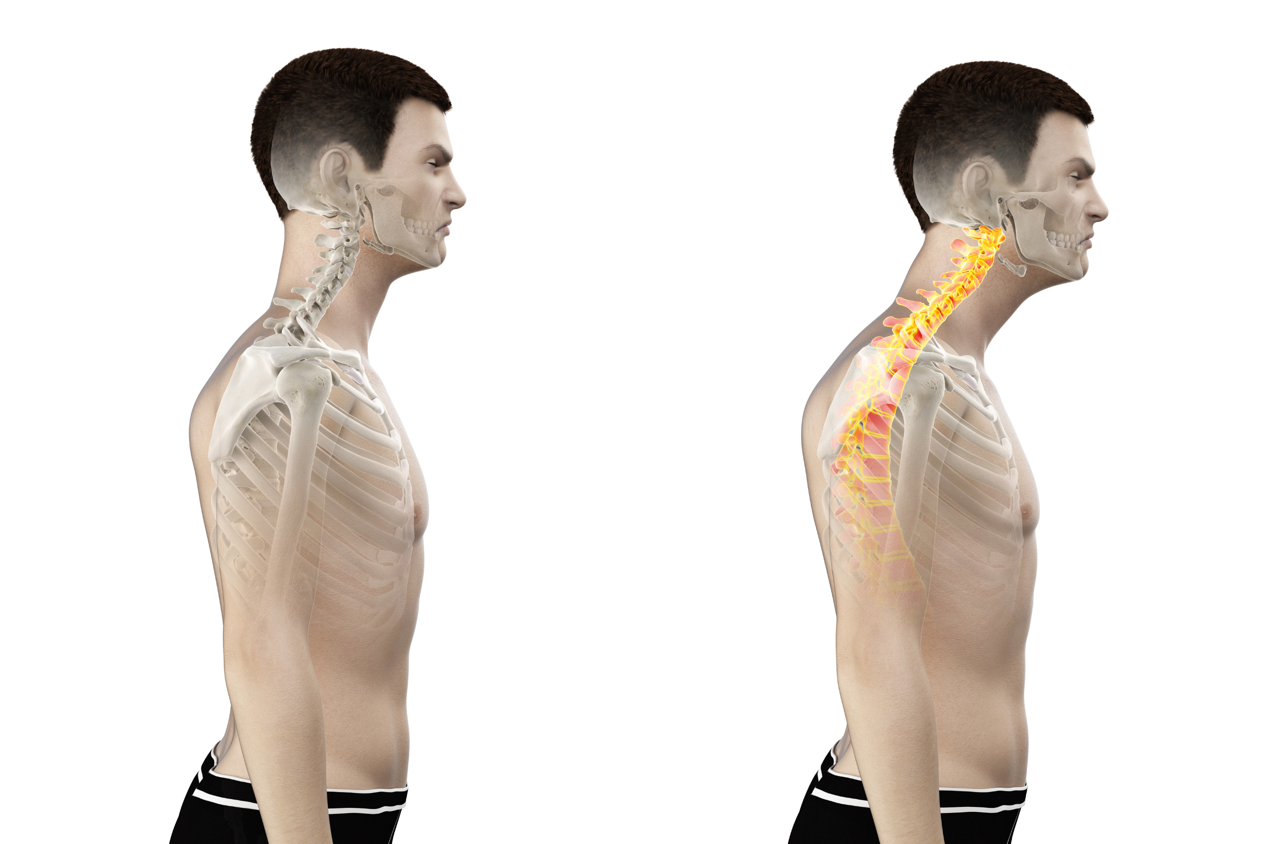 Shoulder and Neck PAIN