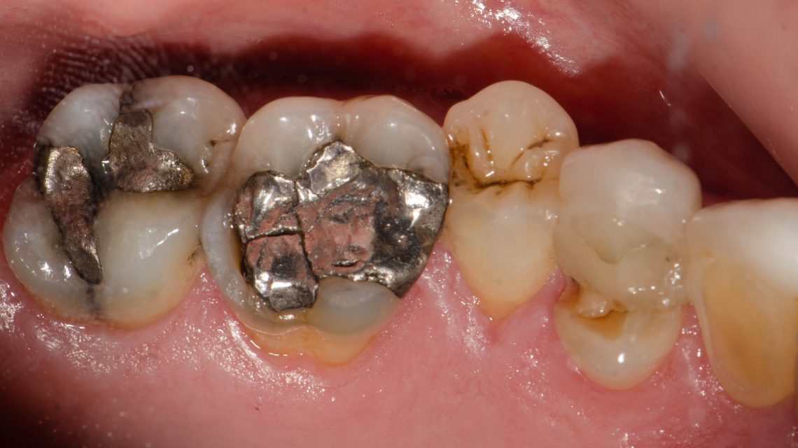 Fractured Molar Cusp or Broken Crown on Molar