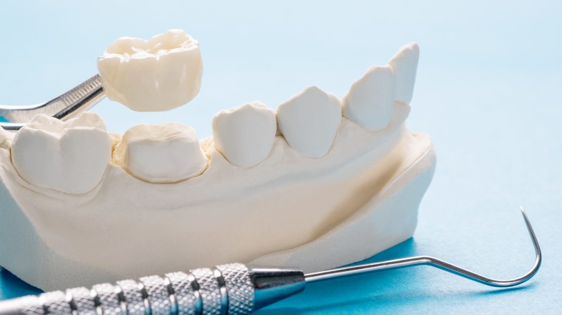 How Long Will My Dental Crown and Filling Last?