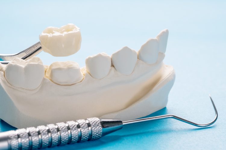 How Long Will My Dental Crown and Filling Last?