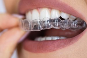 The benefits of clear aligners