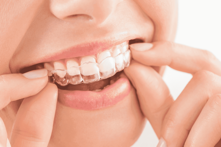 How clear aligners work