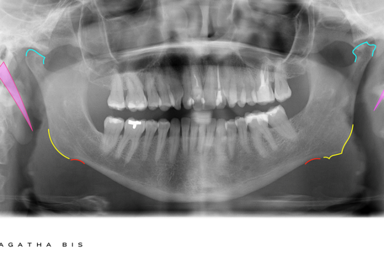 TMJ Disorder & Panorex