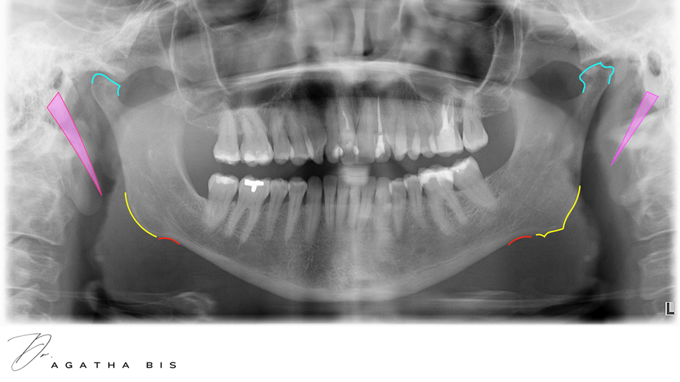 TMJ Disorder & Panorex