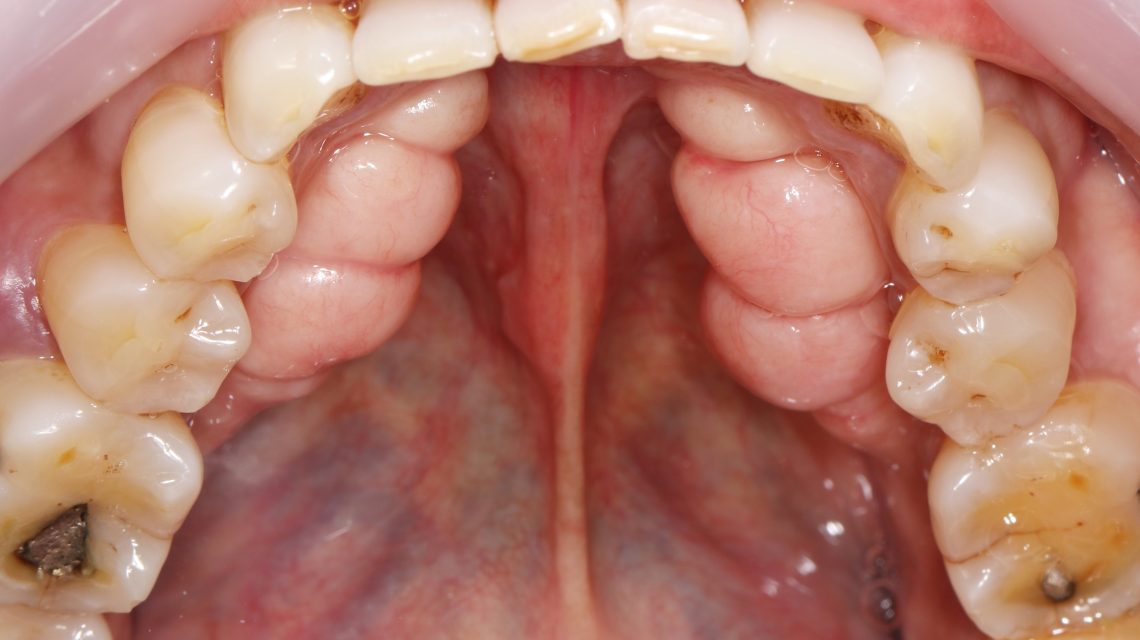 Tori - Excess Bone Growth