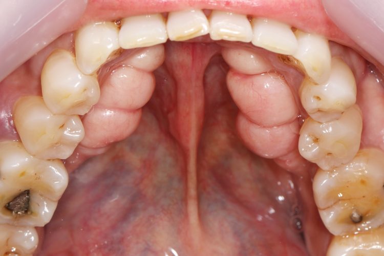 Tori - Excess Bone Growth