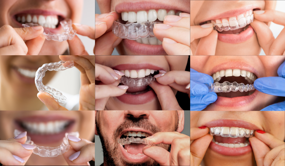 Clear Aligners