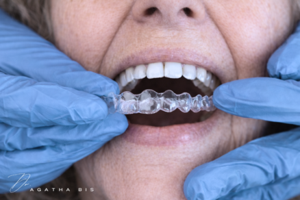 Select Adult Clear Aligners in Oakville: What to Expect During Treatment Adult Clear Aligners in Oakville