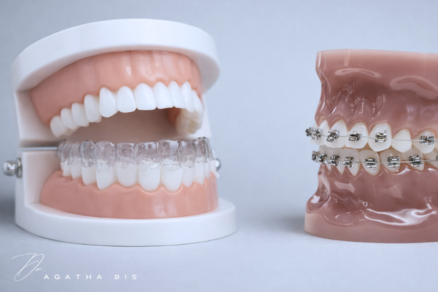 Clear Aligners vs. Braces in Oakville: Which Is Right for You?