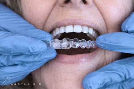 Adult Clear Aligners in Oakville