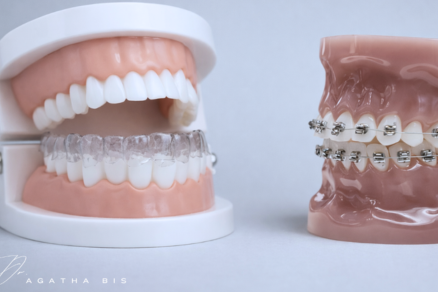 Clear Aligners vs. Braces in Oakville