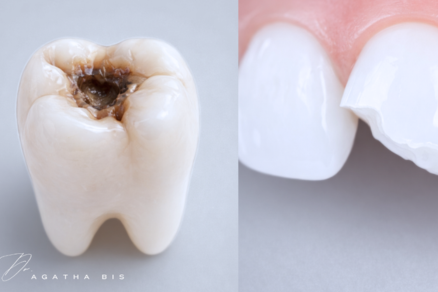 Composite Bonding vs. Composite Fillings in Oakville