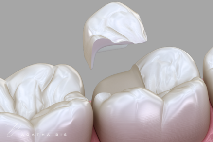Cracked Teeth and Dental Crowns in Oakville
