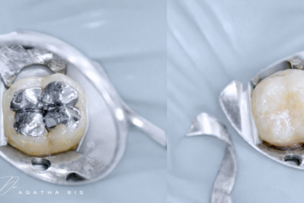Replacing Old Silver Fillings in Oakville