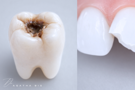 Composite Bonding vs. Composite Fillings in Oakville