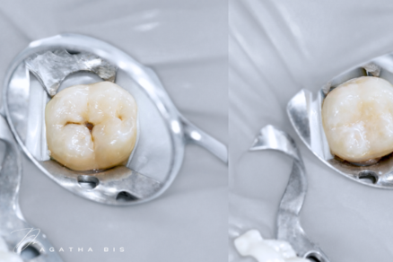 Composite fillings Oakville