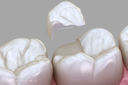 Cracked Teeth and Dental Crowns in Oakville