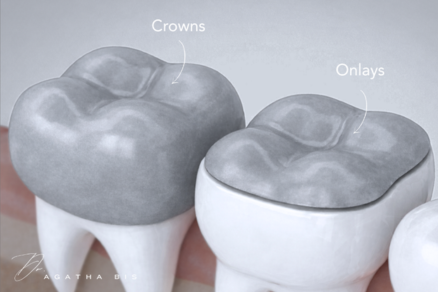 Dental Crowns vs. Onlays in Oakville