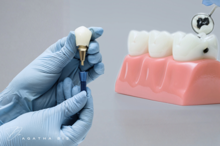 When Does a Filling Need a Crown? Understanding Structural Thresholds in Oakville Dentistry