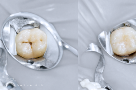 Composite Fillings in Oakville