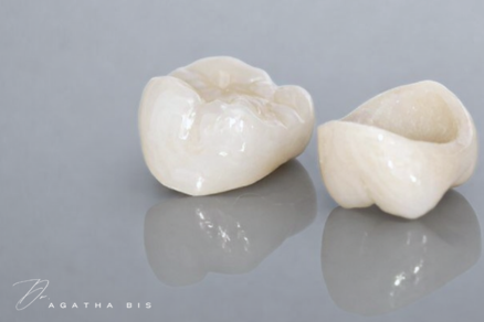 Dental Crowns in Oakville