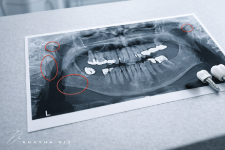 Dental Implant Failure