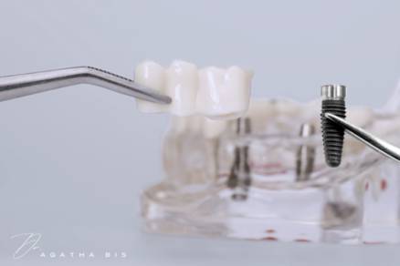 Dental Implants vs. Bridges in Oakville