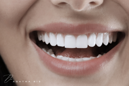 Dental Veneers in Oakville