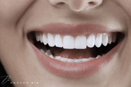 Dental Veneers Oakville